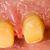 Buffed teeth - prosthetic rehabilitation stock photo © Lighthunter